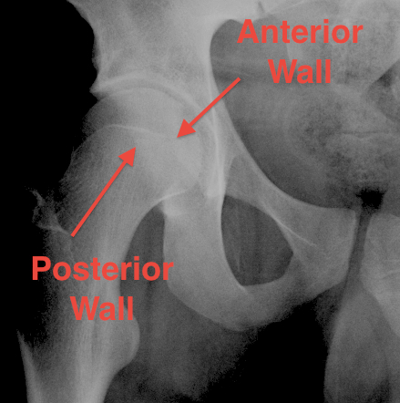 Acetabulum Anterior and Posterior Walls